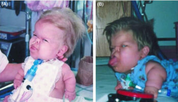 Thanatophoric dysplasia