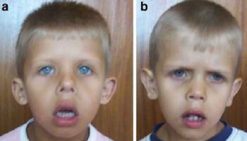 Triple A syndrome