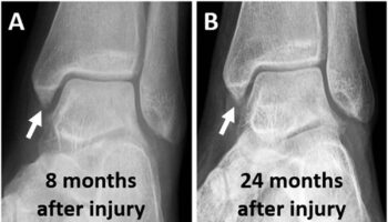 ankle impingement syndrome