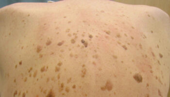 benign skin lesions
