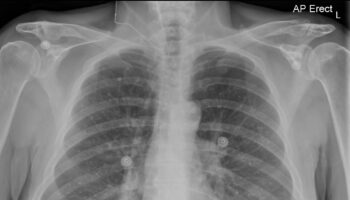 calcified granuloma