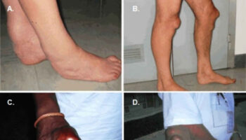 cerebrotendinous xanthomatosis