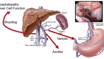 congenital hepatic fibrosis