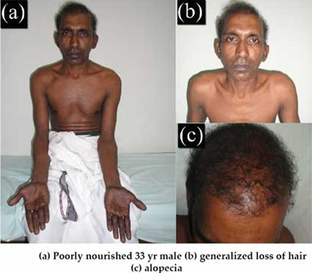 Cronkhite Canada syndrome causes, symptoms, diagnosis, treatment ...