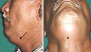 deep neck infection