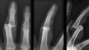 dislocated hand