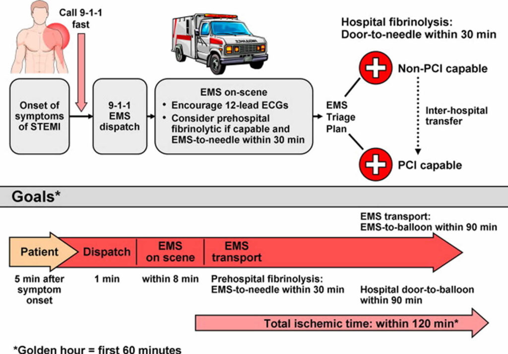 STEMI door to balloon time