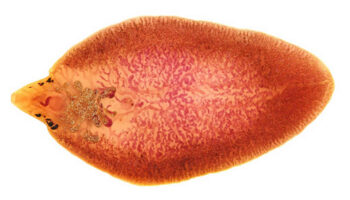 fascioliasis