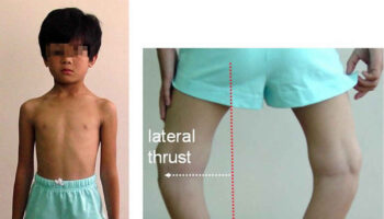 hypophosphatemic rickets
