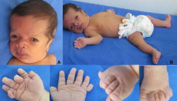 macrocephaly capillary malformation syndrome