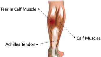 medial gastrocnemius strain