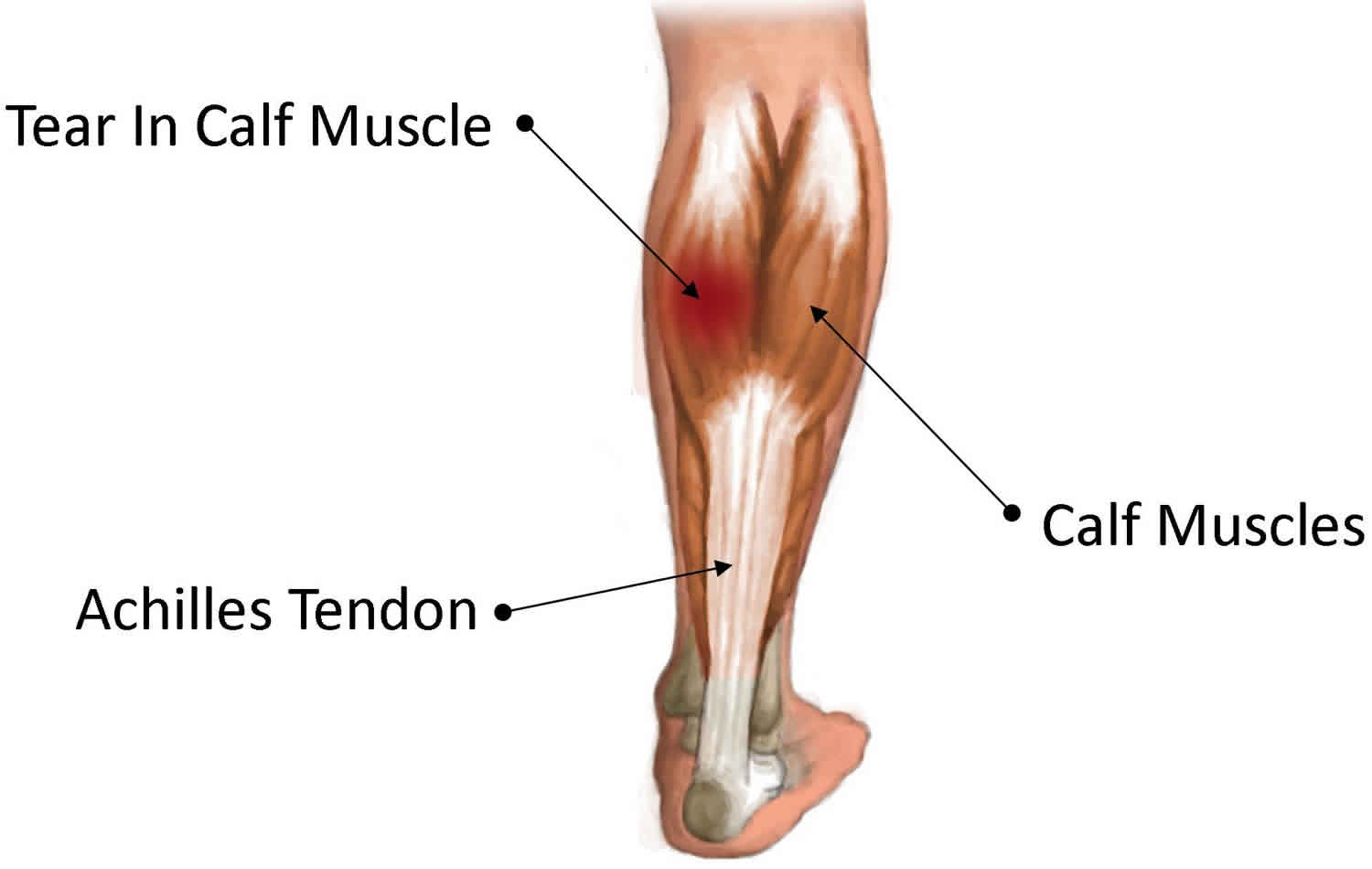 heel lift for calf strain