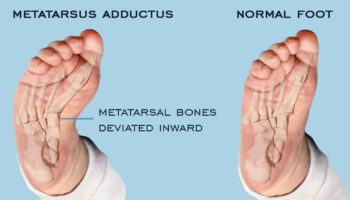 metatarsus-adductus