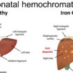 neonatal hemochromatosis