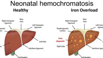 neonatal hemochromatosis