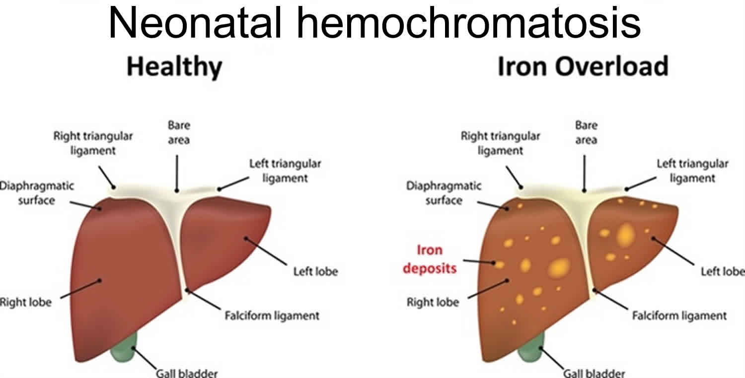 neonatal-hemochromatosis-causes-symptoms-diagnosis-treatment-prognosis