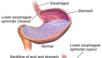 pediatric gastroesophageal reflux
