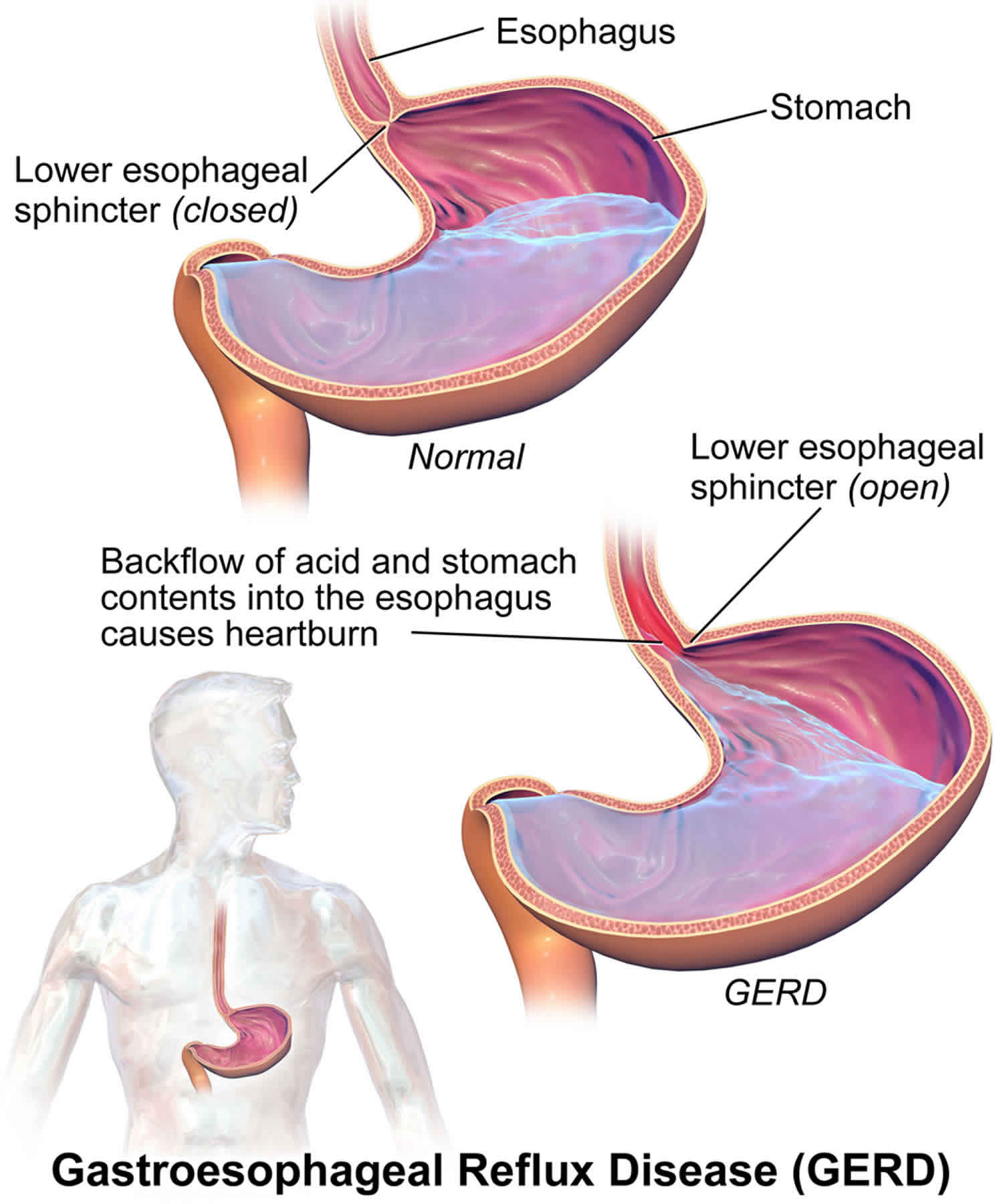 gastroesophageal-reflux-disease