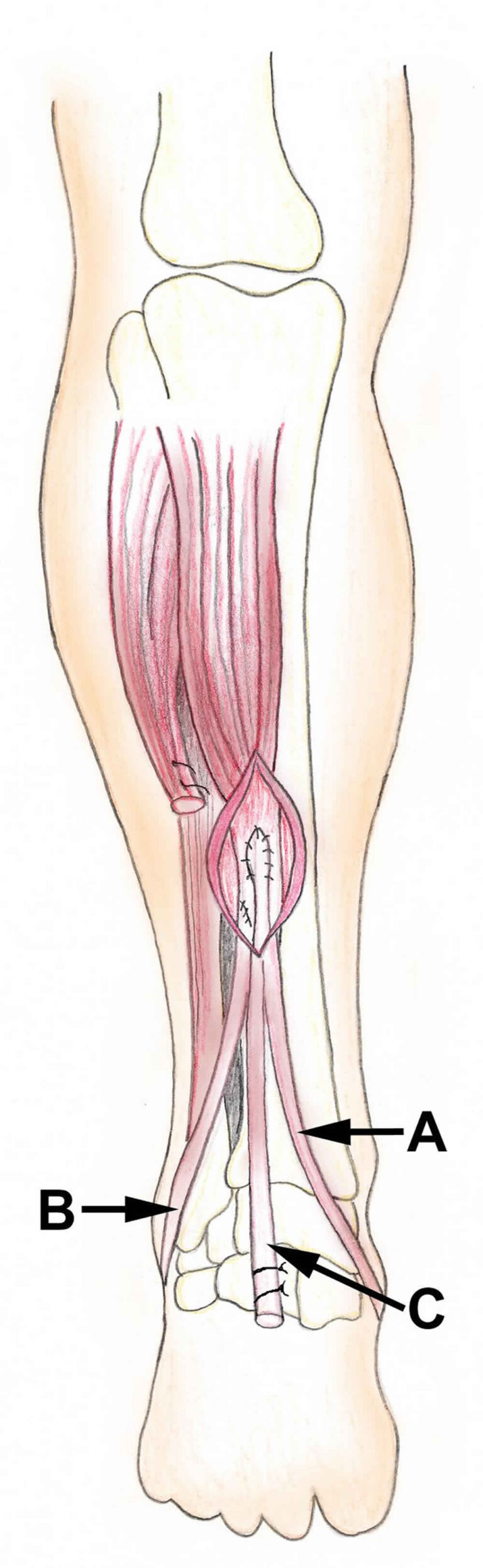 Tendon transfer surgery