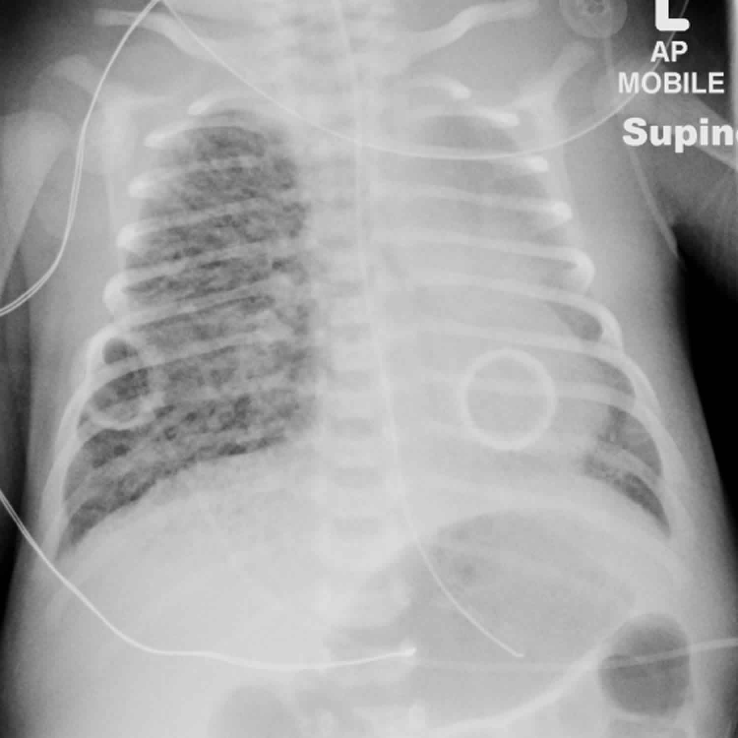 Pulmonary Emphysema X Ray