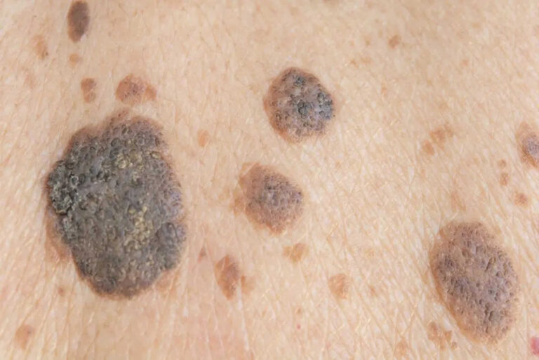 benign-skin-lesions-definition-common-benign-skin-lesions-diagnosis