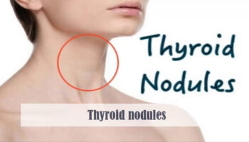 solitary thyroid nodule