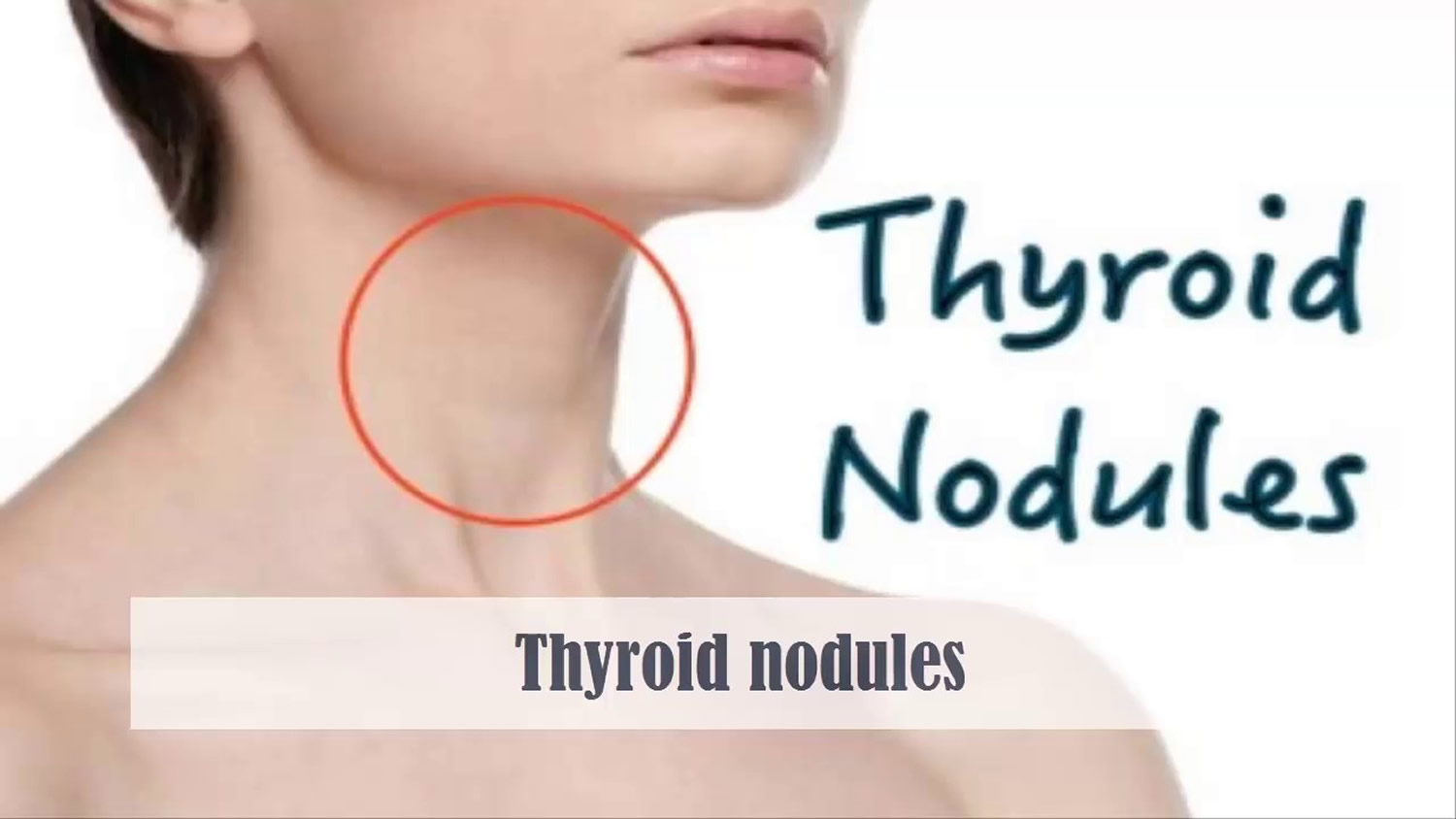 Solitary thyroid nodule causes, symptoms, diagnosis, treatment & prognosis
