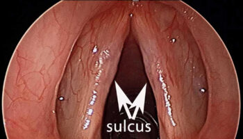 sulcus vocalis