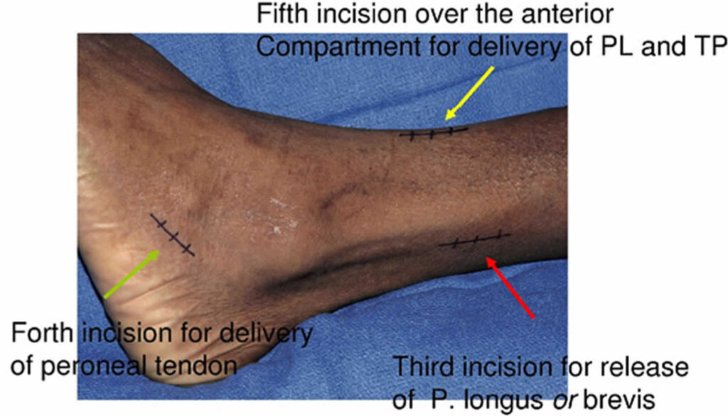 Tendon Transfer Surgery