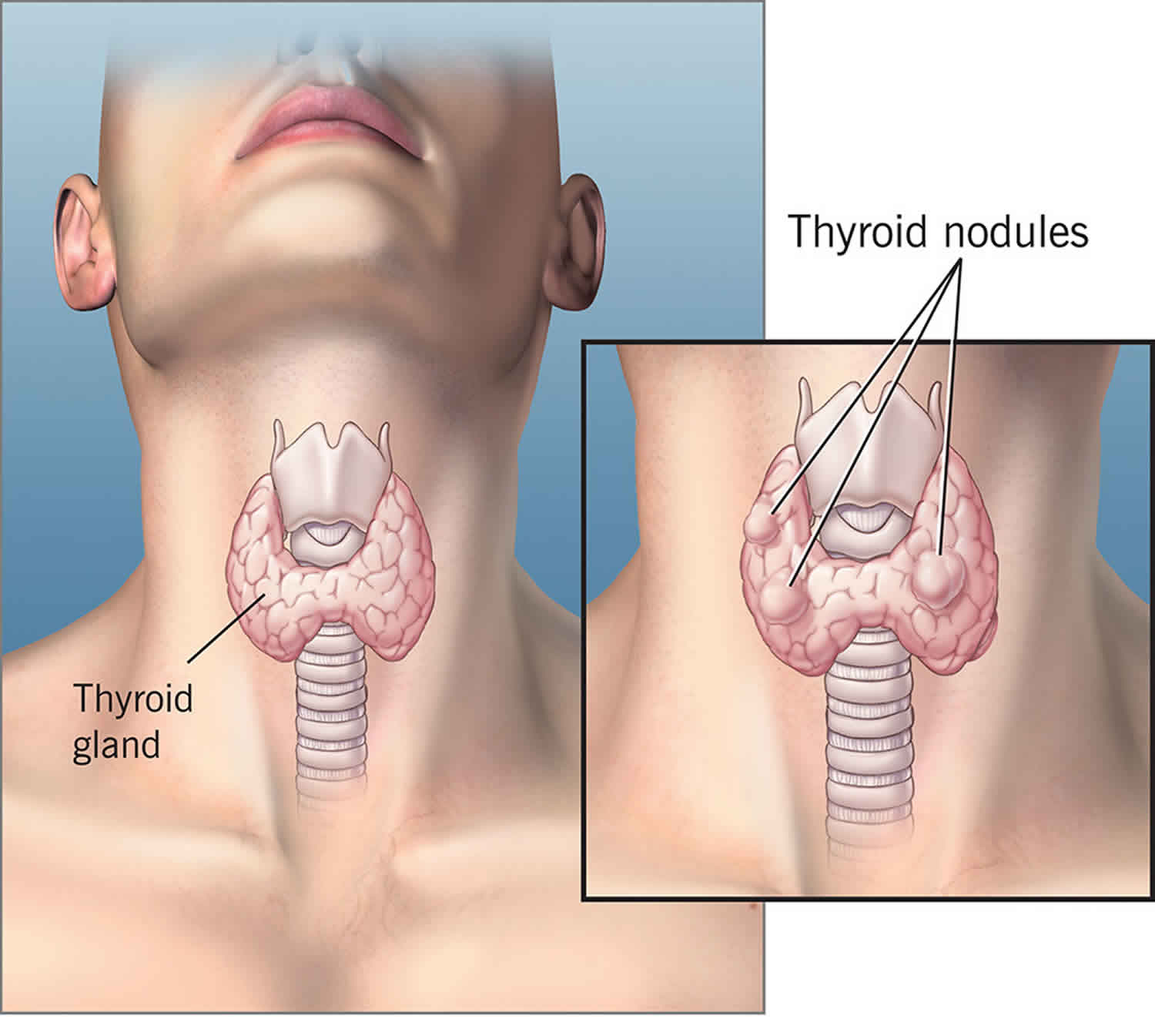 What Symptoms Does A Thyroid Nodule Cause