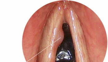 vocal cord cyst