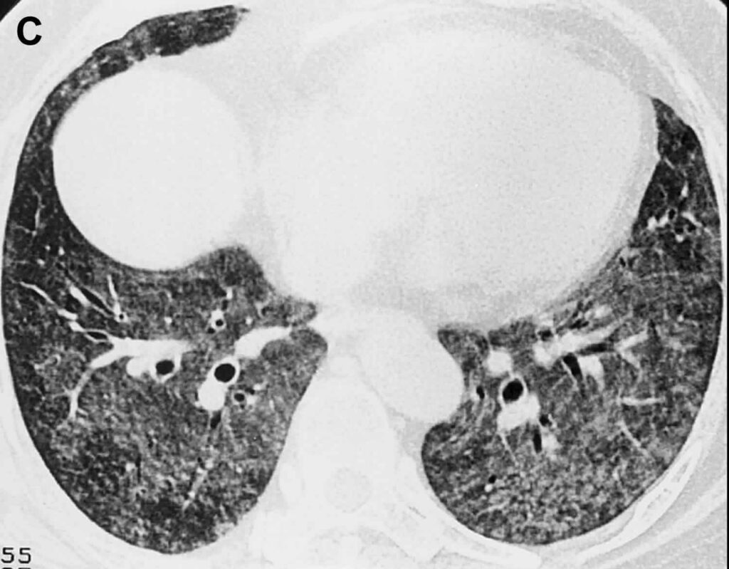 Byssinosis causes, symptoms, diagnosis, treatment & prognosis