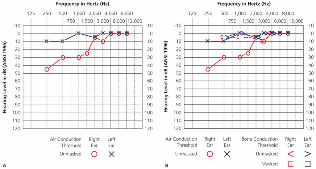 Pure tone audiometry, pure tone audiometry test