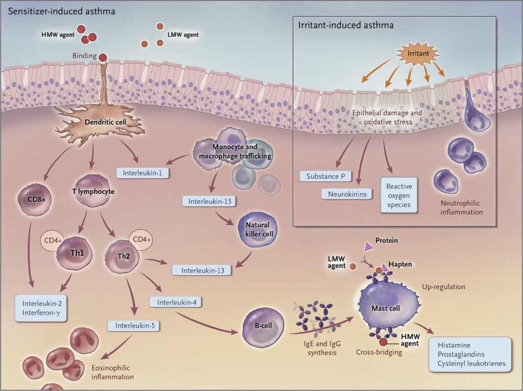 Pathophysiology Of Asthma In Adults