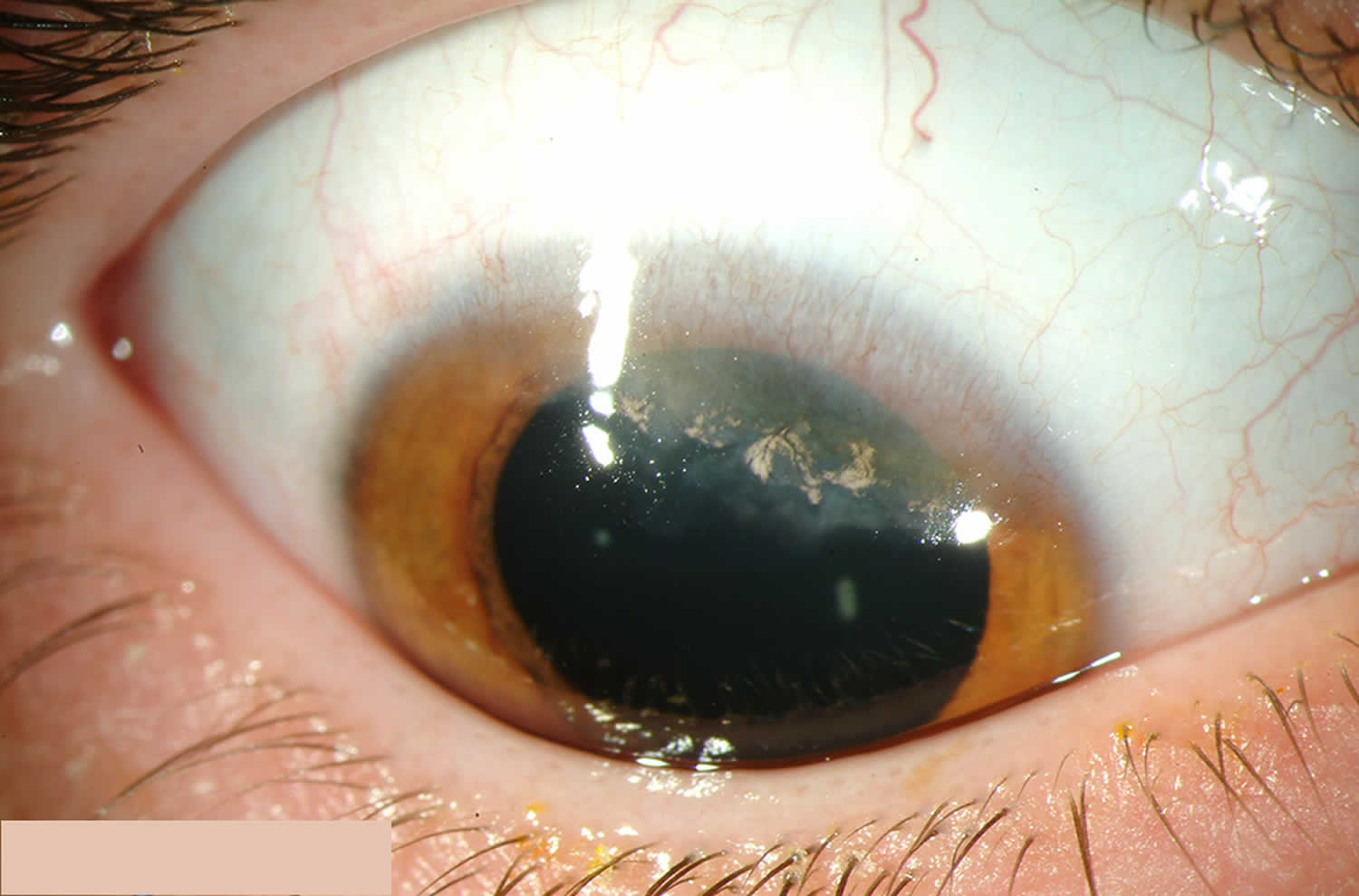 terrien marginal corneal degeneration