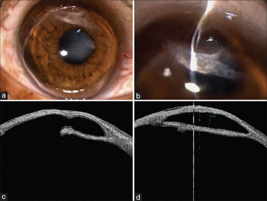 Terriens Marginal Degeneration Causes Symptoms Diagnosis Treatment