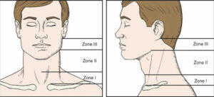 Penetrating trauma causes, types, diagnosis, treatment & prognosis