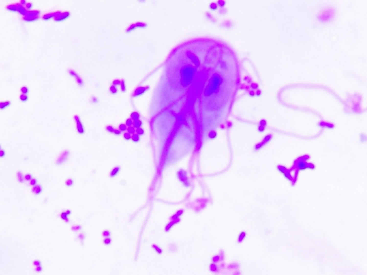 Giardia parasite causes. Echinococcosis- hooklet (hydatid sand) in hydatid fluid