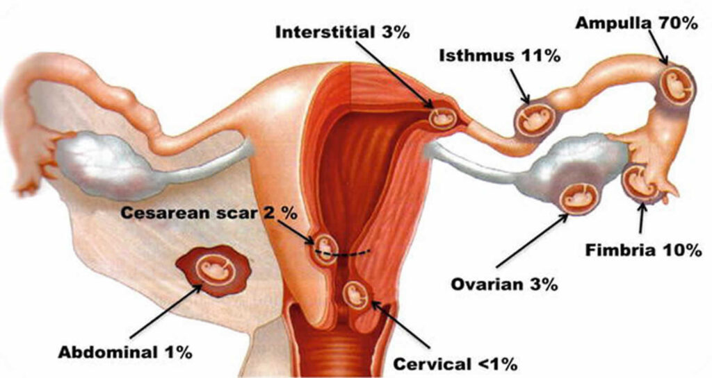 Pain In Hip Ectopic Pregnancy