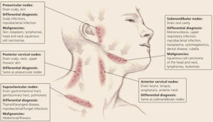 shotty lymph nodes neck