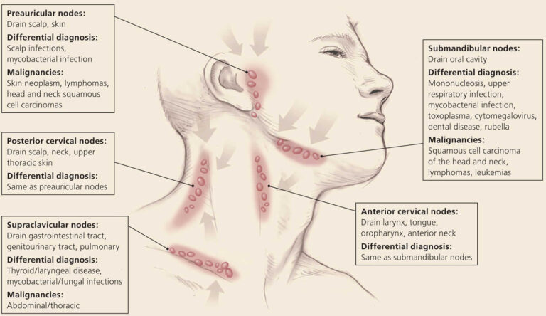 Persistent Generalized Lymphadenopathy Definition Causes Symptoms Diagnosis And Treatment