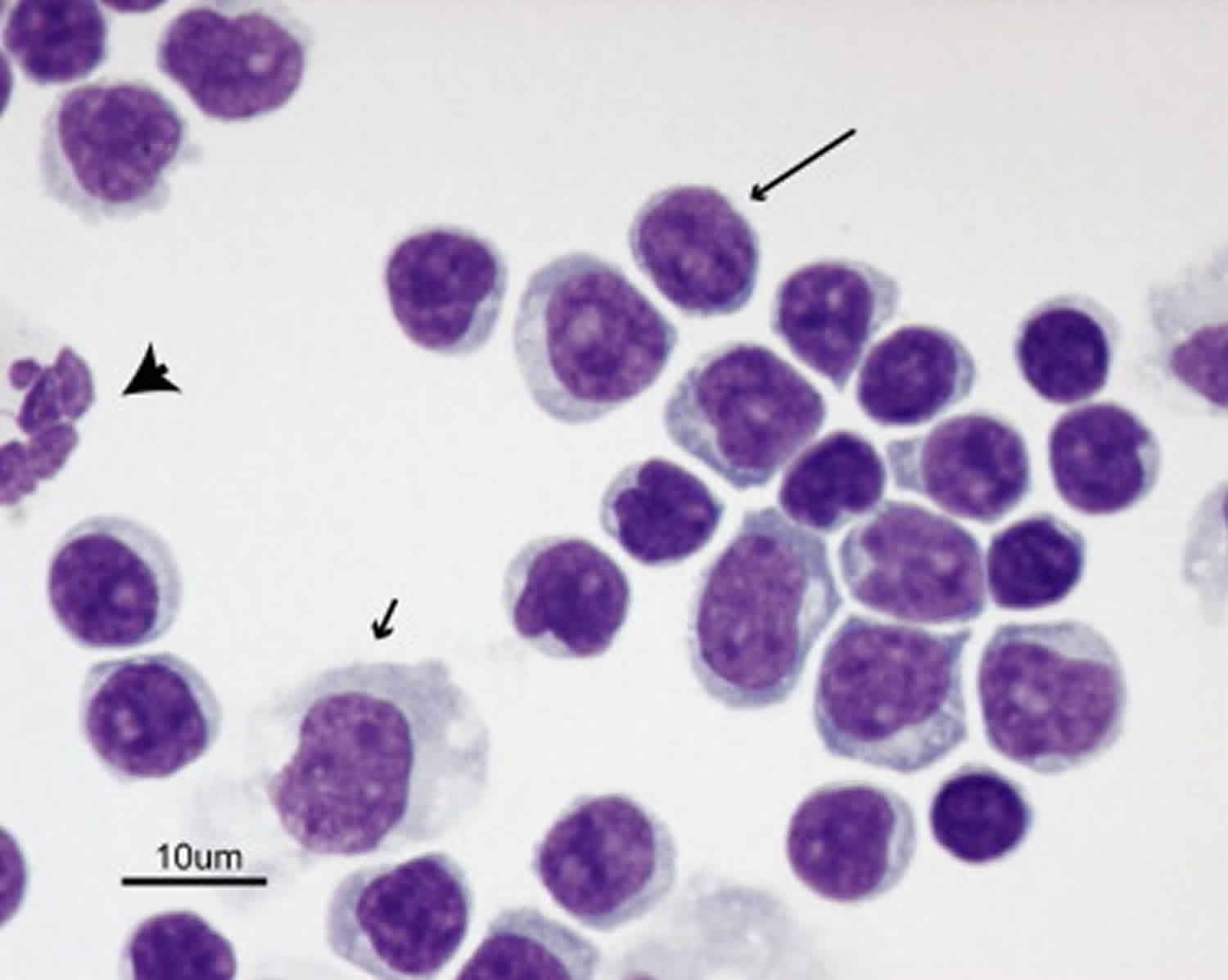 lymphocytic pleocytosis