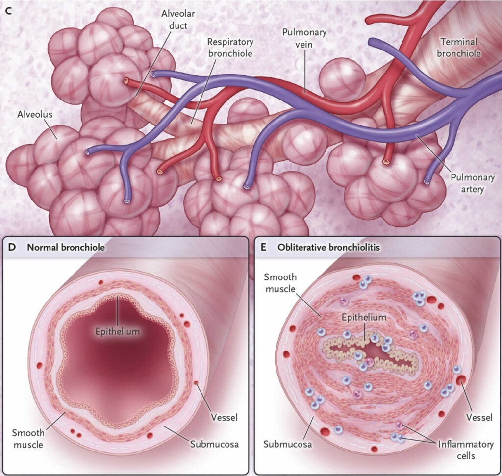 obliterative-bronchiolitis-causes-symptoms-diagnosis-treatment