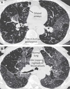 Obliterative Bronchiolitis Causes, Symptoms, Diagnosis, Treatment 