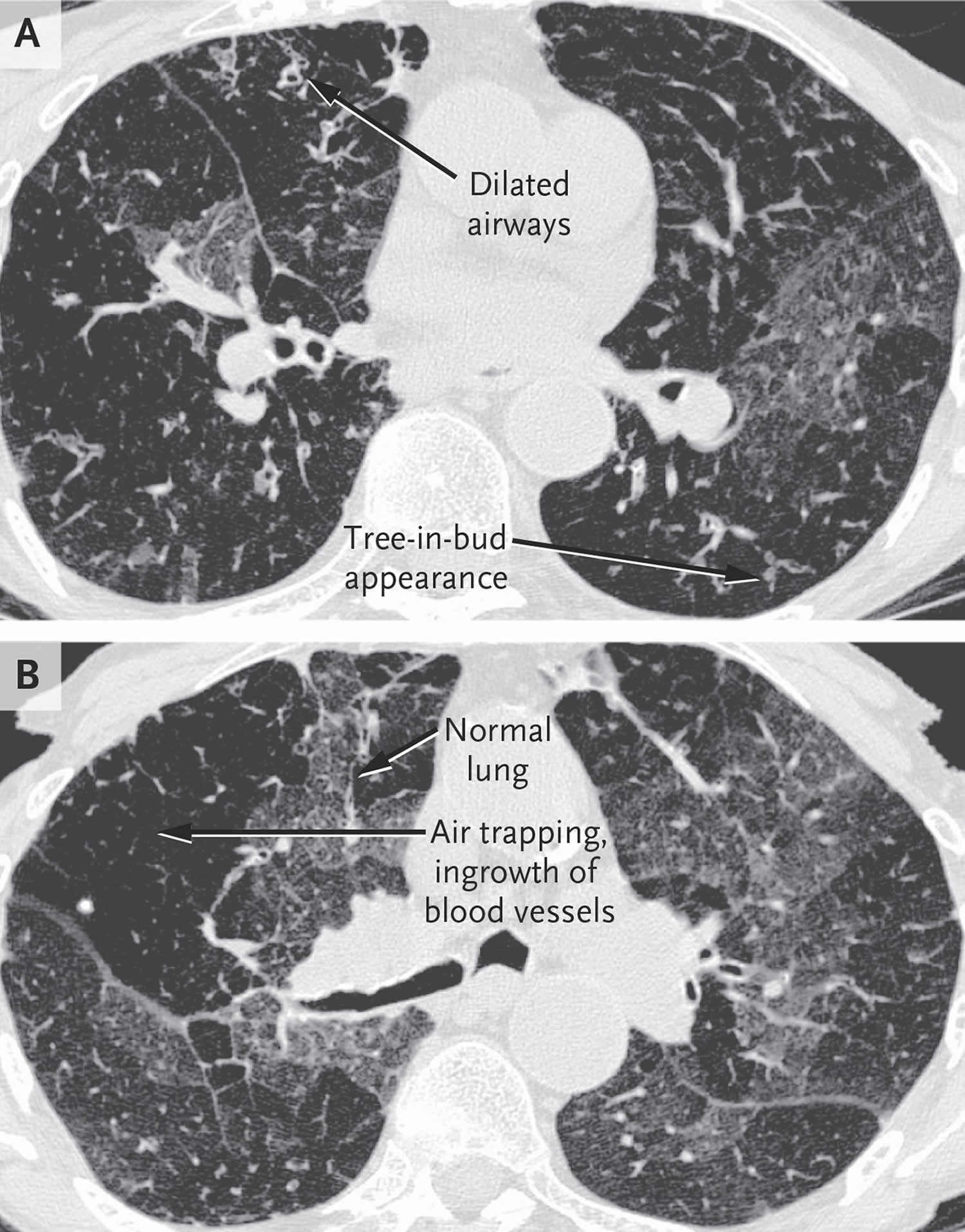 obliterative-bronchiolitis-causes-symptoms-diagnosis-treatment