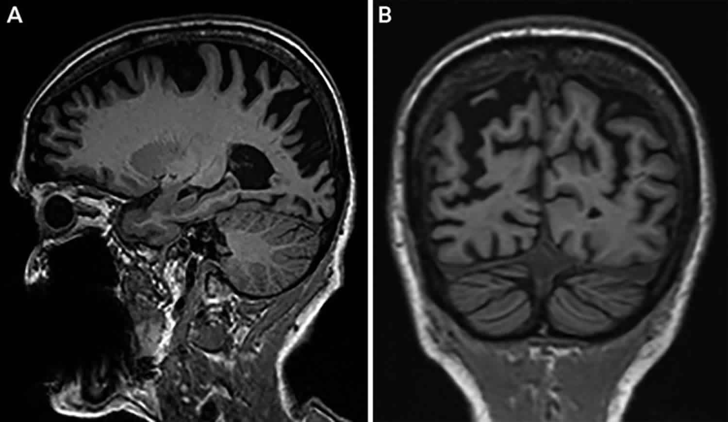 Posterior Cortical Atrophy Causes, Symptoms, Diagnosis, Treatment ...