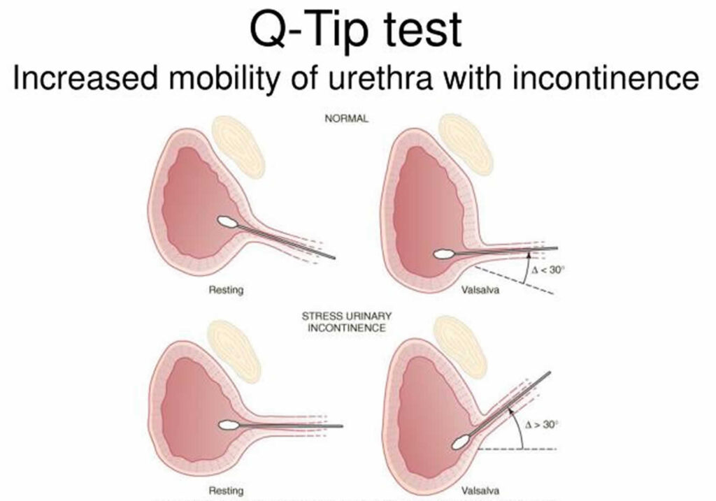 Urethral hypermobility causes, symptoms, diagnosis, treatment & prognosis