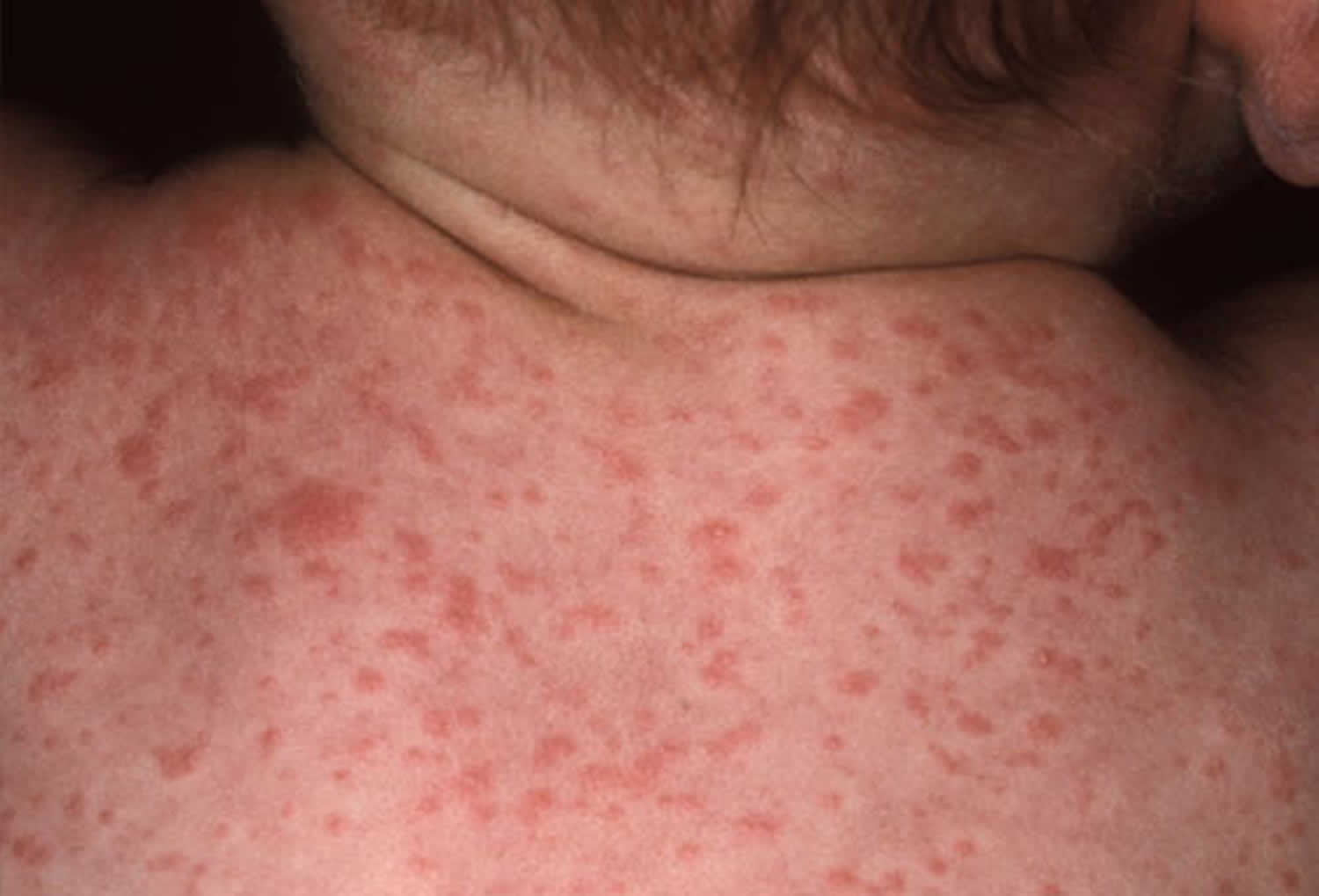 Typhoid Fever Rose Spots