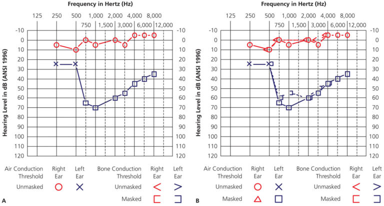 Pure tone audiometry, pure tone audiometry test