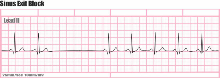 Sinoatrial block definition, causes, symptoms, diagnosis, treatment ...